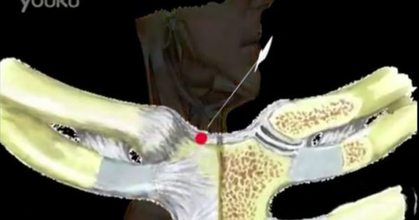 小针刀视频教程张天民中国针刀医学3D动画演示50集完整版插图6